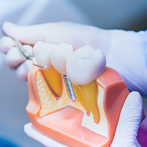An image of a dental model with a mechanical tooth implant being prepared by a dentist s hand.