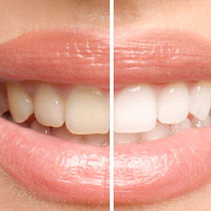 Two-panel image showing a transformation from a person s natural teeth to a set of artificial, white teeth with a focus on cosmetic dental procedures.